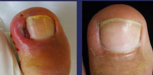 Parche correctivo Uñas Encarnadas