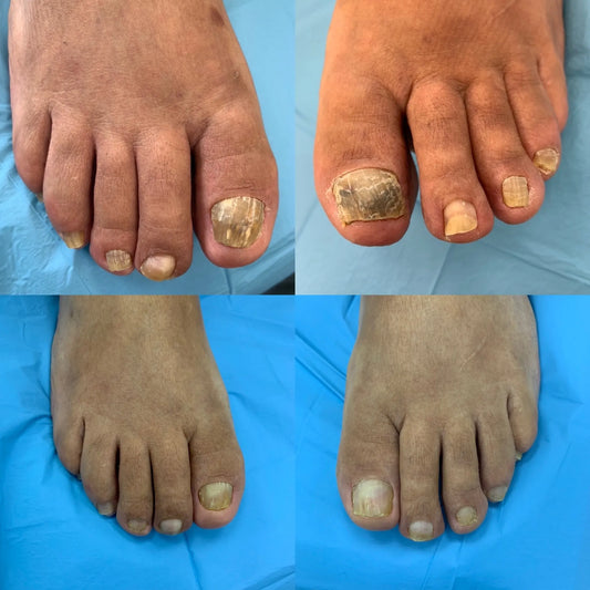 Parches para Hongos en las Uñas