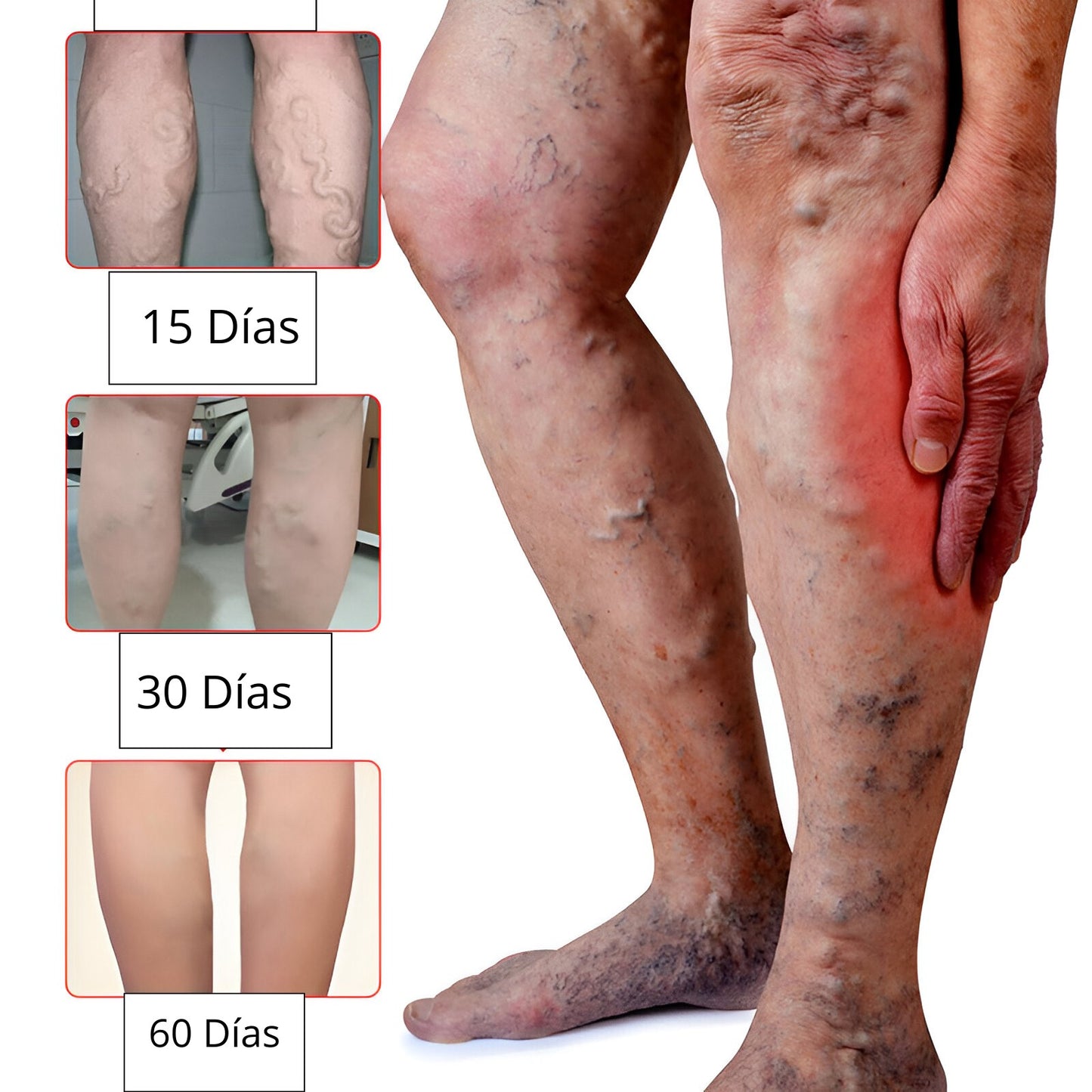 Parches para Varices