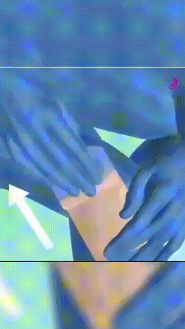 Parches para Varices